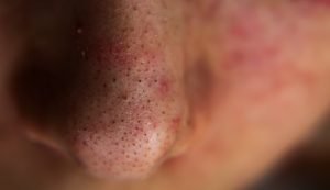 What is Blackheads?