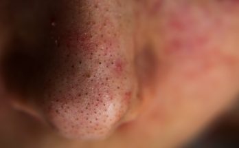 What is Blackheads?