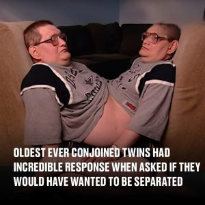 Oldest ever conjoined twins had incredible response when asked if they would have wanted to be separated