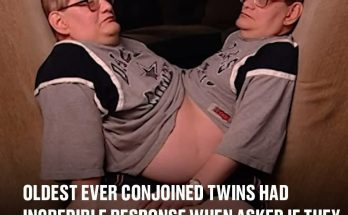 Oldest ever conjoined twins had incredible response when asked if they would have wanted to be separated