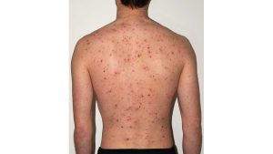 Chickenpox symptoms and cause