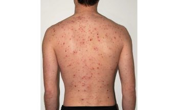 Chickenpox symptoms and cause