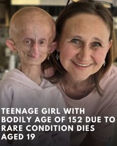 Teenage Girl With Bodily Age Of 152 Due To Rare Condition Dies Aged 19