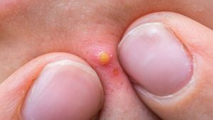 How to Heal a Big Pimple That Won't Go Away