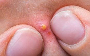 How to Heal a Big Pimple That Won't Go Away