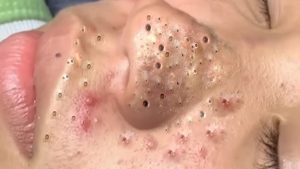 Nose Blackhead Removal and Treatment