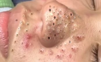 Nose Blackhead Removal and Treatment