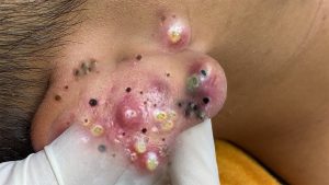 Blackhead removed and treatment