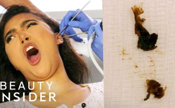 How Earwax Is Professionally Extracted | Beauty Explorers