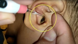 BIGGEST EARWAX REMOVAL | Huge Ear Wax Finally Removed After 10 Years