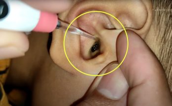 BIGGEST EARWAX REMOVAL | Huge Ear Wax Finally Removed After 10 Years