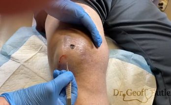 TREATMENT Removal of drainage of a knee hematoma COMMITTED TO NOT RECURRING, NOT LEAVING SCARS