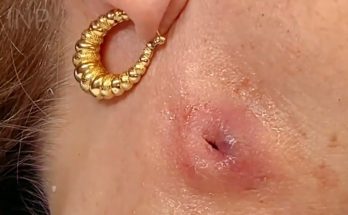 Removed infected cyst and special treatment