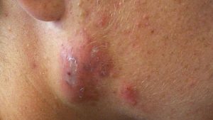 Cystic Acne:Causes, Symptoms
& Treatments