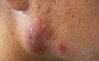 Cystic Acne: Causes, Symptoms & Treatments