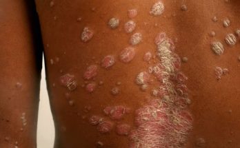 SERIOUS Diseases Diagnosed Via Skin Signals!