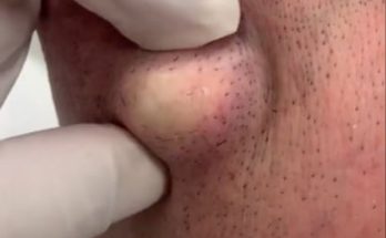 Blackheads: Causes, Symptoms, and Treatments