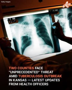 Kansas Tuberculosis Outbreak, Largest in US History, Hits 67 Active Cases Across Two Counties – Latest Details