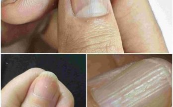 Understanding Why You Have Lines on Your Nails