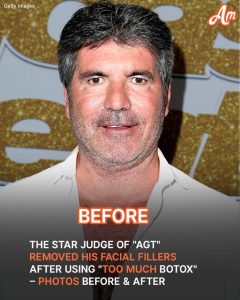 'AGT' Star Simon Cowell Removed His Facial Fillers After Not Recognizing Himself – Before & After Photos