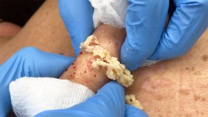 What to Expect From a Sebaceous Cyst Removal