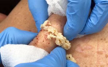 What to Expect From a Sebaceous Cyst Removal