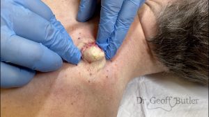 What does an epidermal inclusion cyst