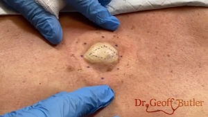 TREATMENT OF Epidermal Cyst on Back IS COMMITTED TO NOT RECURRING, NOT LEAVING SCARS