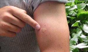 Signs Your Bug Bite is Something Serious