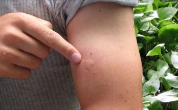 Signs Your Bug Bite is Something Serious