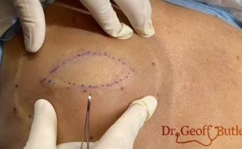 Removal of a large epidermal cyst on the back of the leg