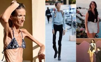 ‘I’m not going to teach young girls how to d.i.e’: World’s Thinnest Woman Receives Fan Mail to Be Like Her…