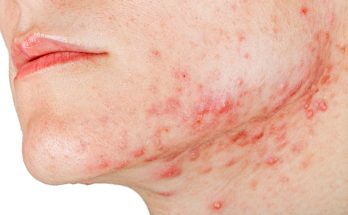 What Causes Jawline Acne? Discover the Surprising Truth