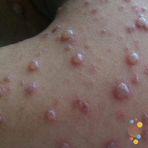 Chickenpox Symptoms, Causes, and Diagnosis for All Ages