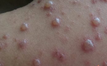 Chickenpox Symptoms, Causes, and Diagnosis for All Ages