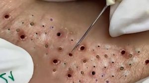 What is blackheads? How to remove, prevention and treatment