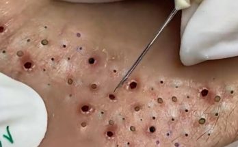 What is blackheads? How to remove, prevention and treatment