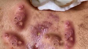 Big Cystic Acne Blackheads Extraction Blackheads & Milia, Whiteheads Removal Pimple Popping