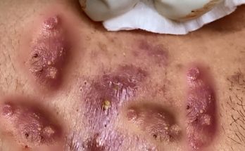 Big Cystic Acne Blackheads Extraction Blackheads & Milia, Whiteheads Removal Pimple Popping