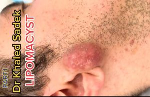 What is blackheads? How to remove, prevention and treatment