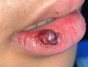 TREATMENT Removal of Removal of a pyogenic granuloma on the lipIS COMMITTED TO NOT RECURRING, NOT LEAVING SCARS