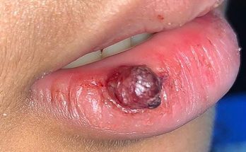 TREATMENT Removal of Removal of a pyogenic granuloma on the lipIS COMMITTED TO NOT RECURRING, NOT LEAVING SCARS