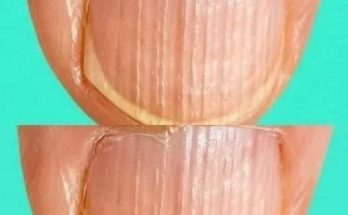 Doctor Reveals 7 Health Conditions You Can Spot By Just Checking Your Nails