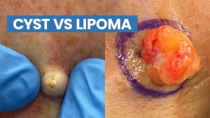 Cyst VS Lipoma