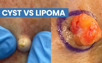 Cyst VS Lipoma