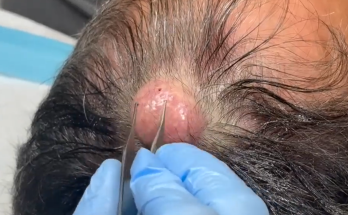 TREATMENT OF Removal of a decent sized pilar cyst on the scalp