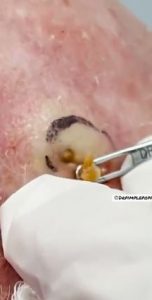 The Biggest Dilated Pore of Winer?! THERAPY Biggest Dilated Pore avoiding reoccurring and leaving scars