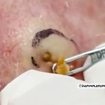 The Biggest Dilated Pore of Winer?! THERAPY Biggest Dilated Pore avoiding reoccurring and leaving scars