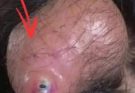 Why Your Pores Might Be the Real Reason You’re Still Breaking Out